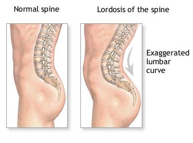 Image showing Lordosis