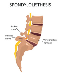 image describing spondylolisthesis