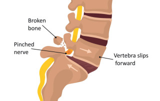 image describing spondylolisthesis