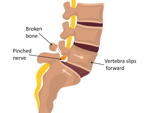Treatment and Corrective Exercises for Spondylolisthesis in Harrogate and North Leeds 