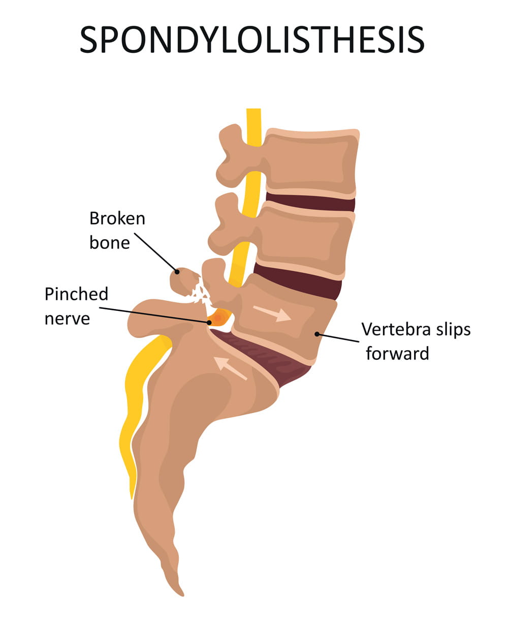 image describing spondylolisthesis
